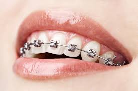 Orthodontist Bundoora – gwpdental